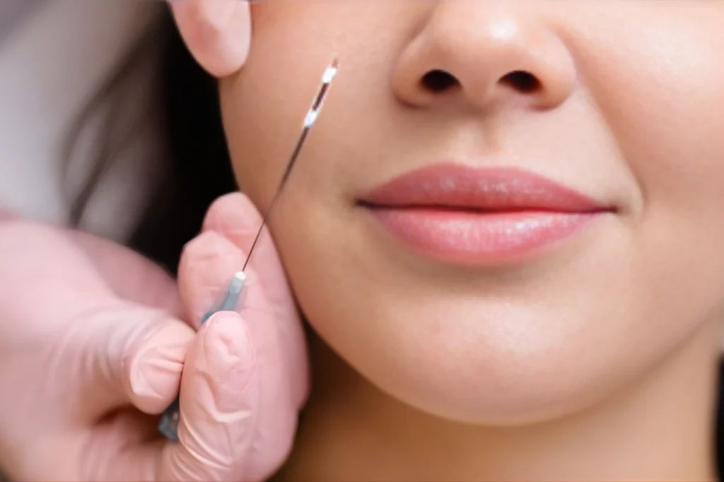 thread lift nonsurgical face lifting